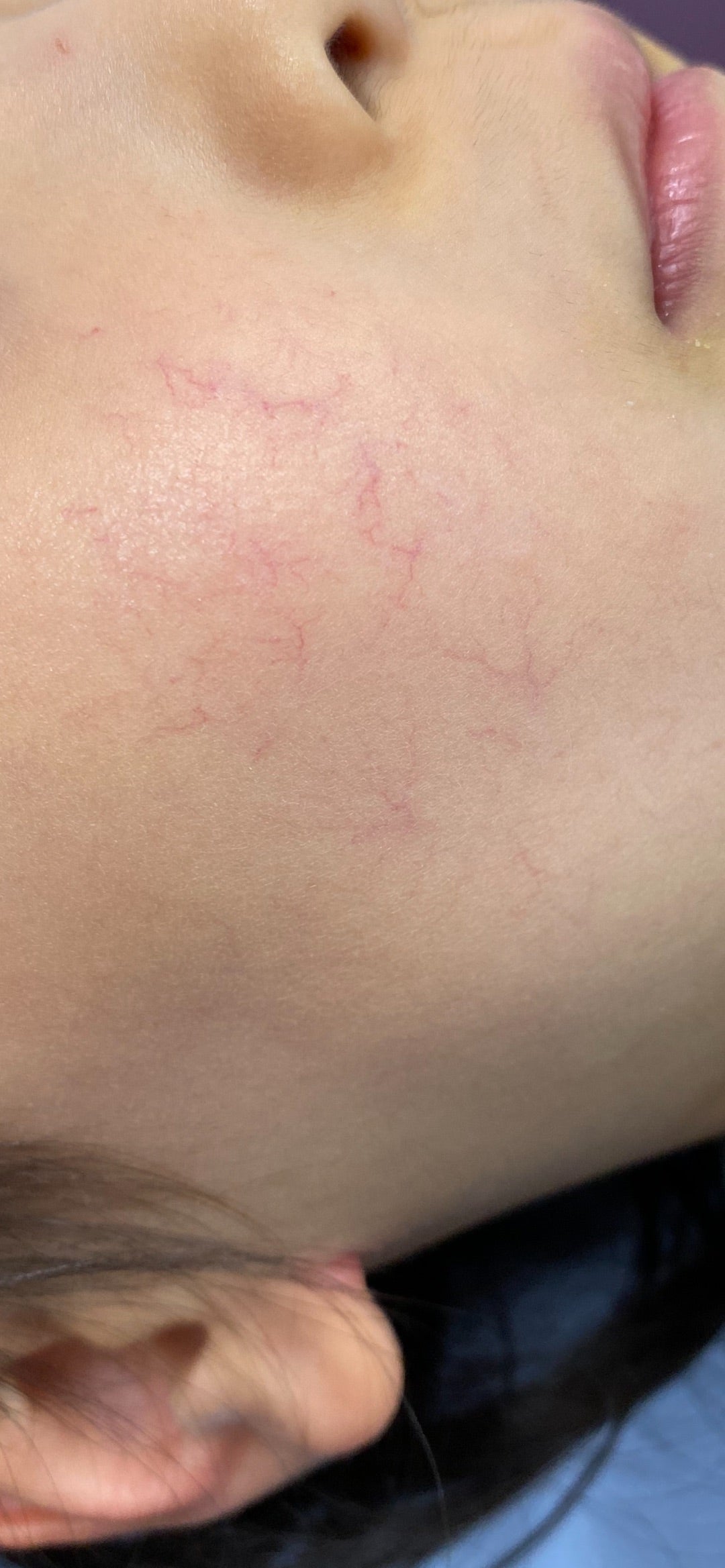 メーラーファット除去ほうれい線・ゴルゴラインを目立たなくする方法とは美容整形のことなら千葉 船橋・銀座の東京形成美容外科・美容皮膚科