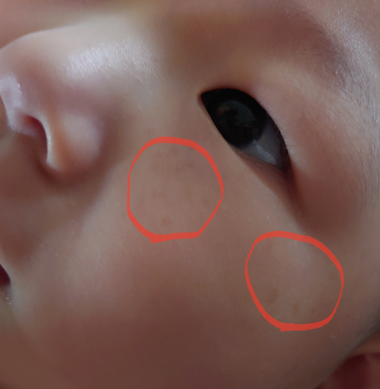 お子様の皮膚疾患についてきむら内科小児科クリニック名古屋市緑区