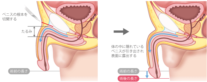 勃起力チェック】フル勃起時の角度や硬さ、持続時間からED診断｜薬の通販オンライン