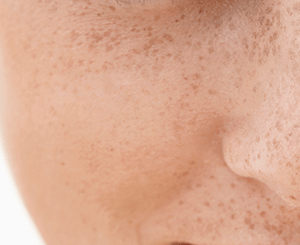 しみ・そばかすは30代から～美容との区別が重要に～こちら診察室時事メディカル時事通信の医療ニュースサイト