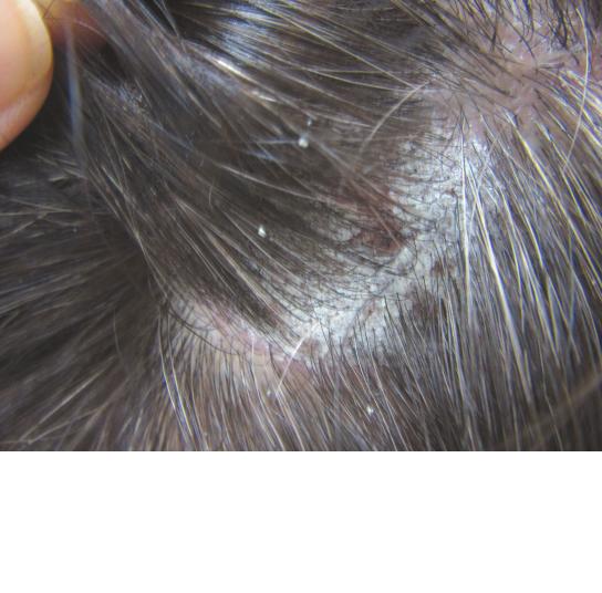 子どもの皮膚疾患について横浜市 東神奈川の神奈川はた皮膚科クリニック