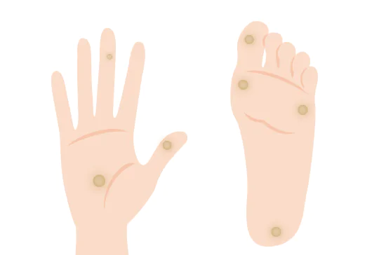 子供の足裏にできたイボ 足底疣贅・尋常性疣贅・ミルメシア の写真素材90112757- PIXTA