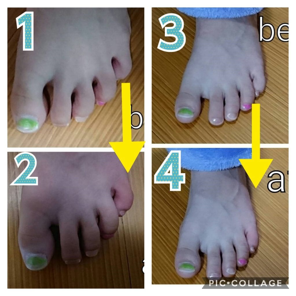 子どもの足指がねじれている？！カーリートゥ 巻き趾 ってどんな足