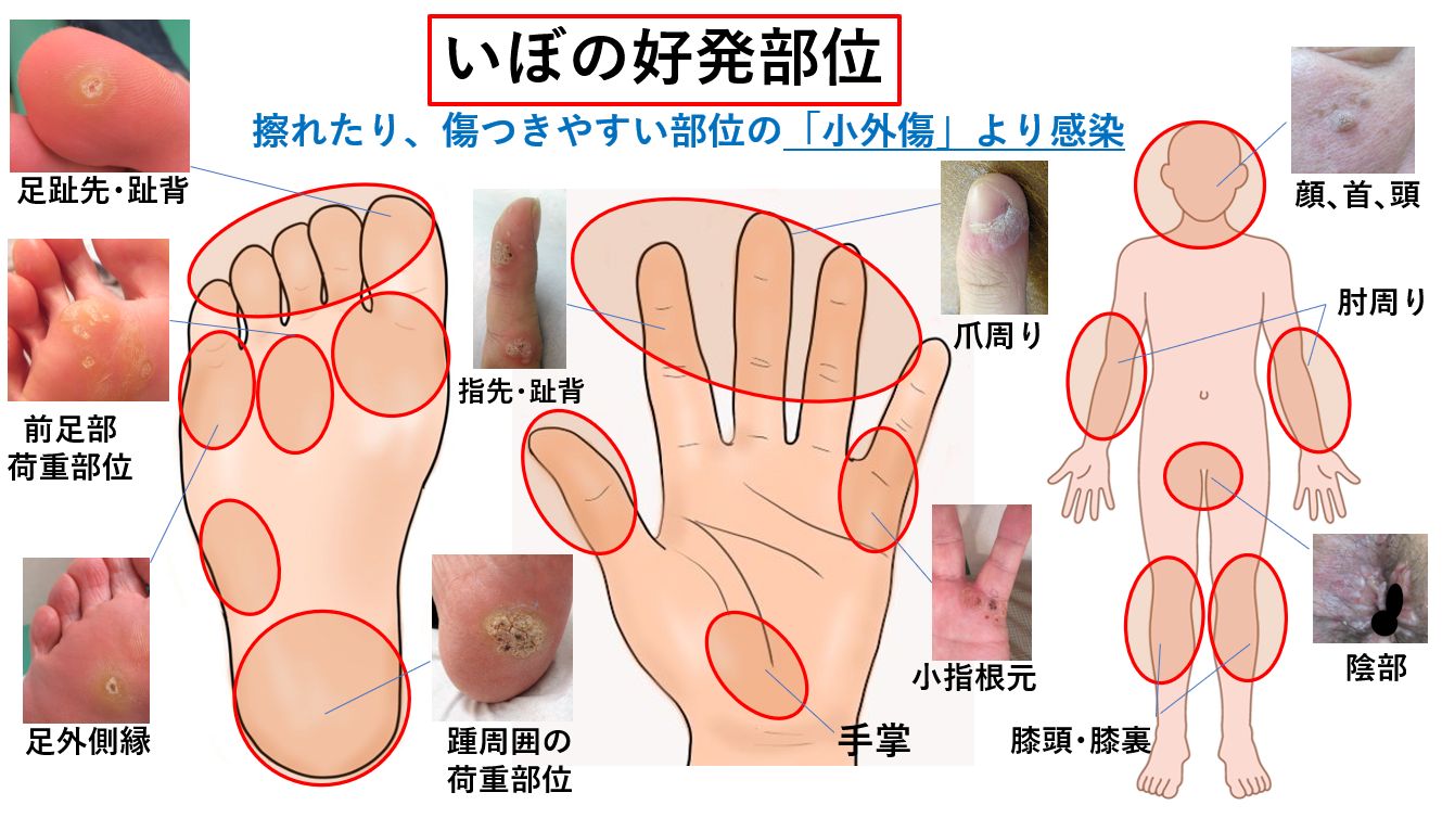 足のイボはウイルスによる感染症。よく似ている魚の目とタコとの見分け方 魚の目・タコ・イボ毎日が発見ネット