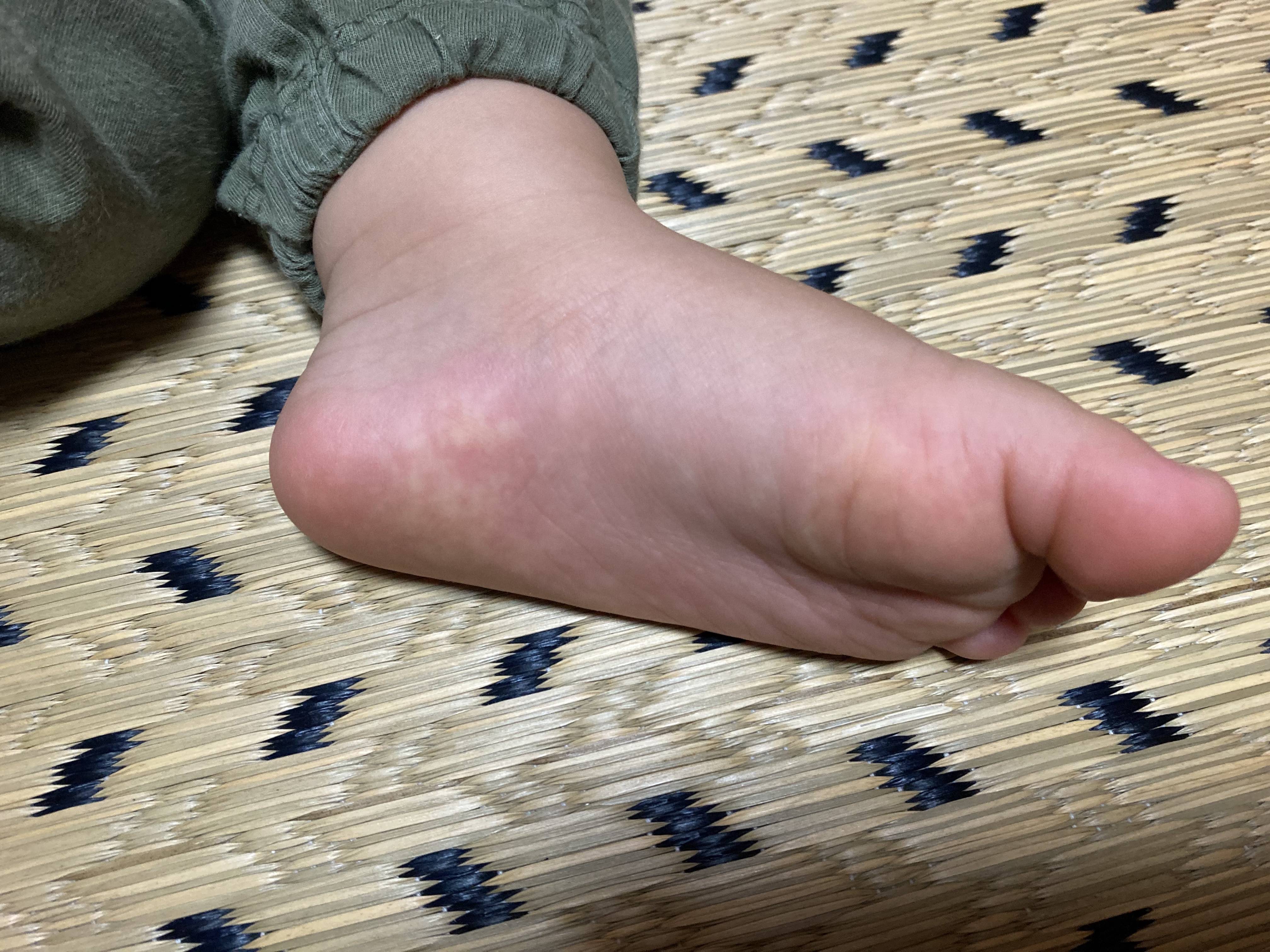 先天性股関節脱臼とは？原因や症状は？見分け方はあるの？ - こそだてハック