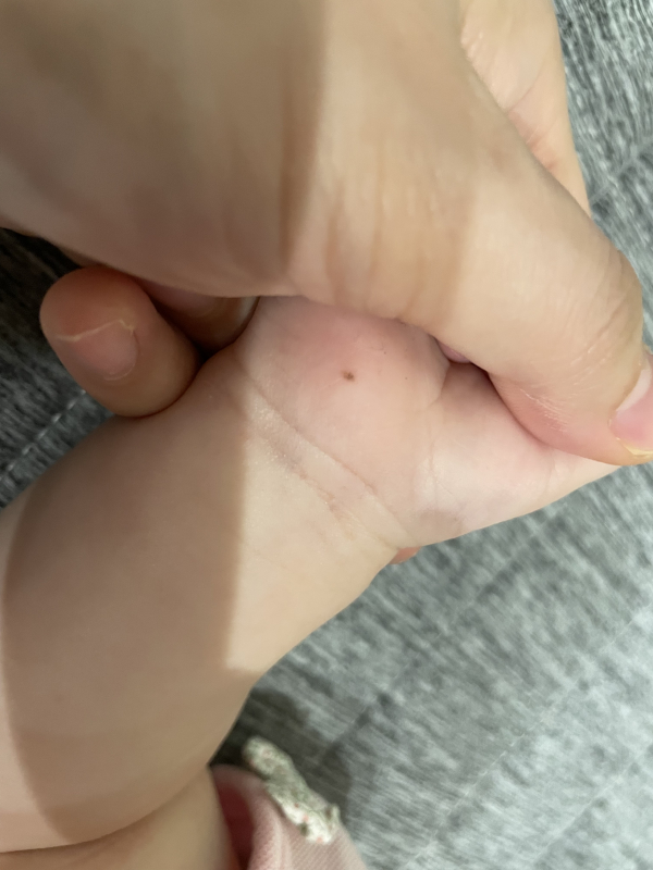 赤ちゃんにほくろ発見！悪いほくろの見分け方＆ほくろの除去ベビリナ