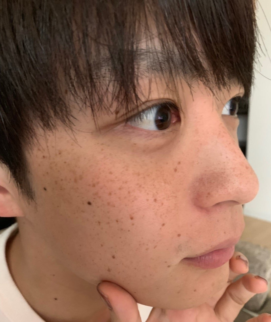 そばかす除去レーザー治療大船T's形成クリニック