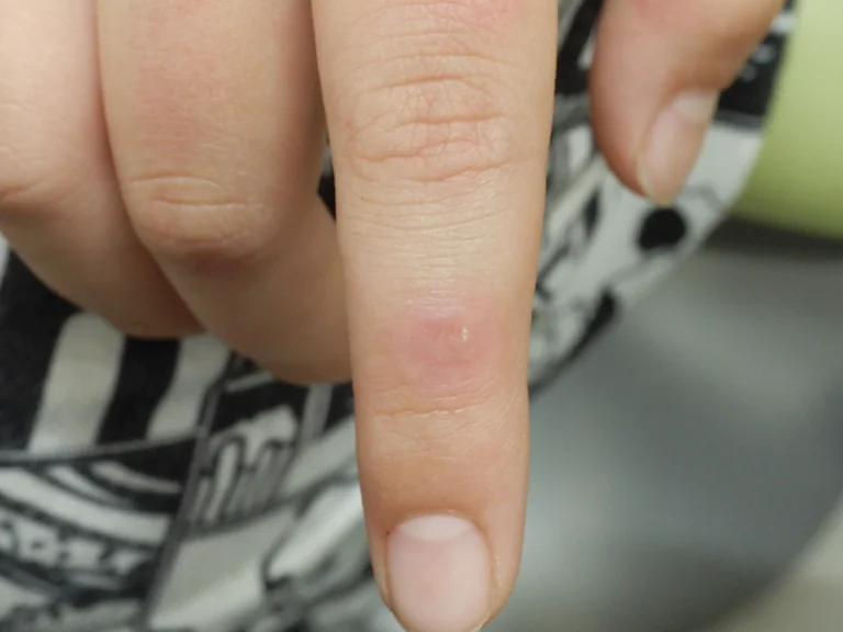 いぼ埼玉県皮膚科医会