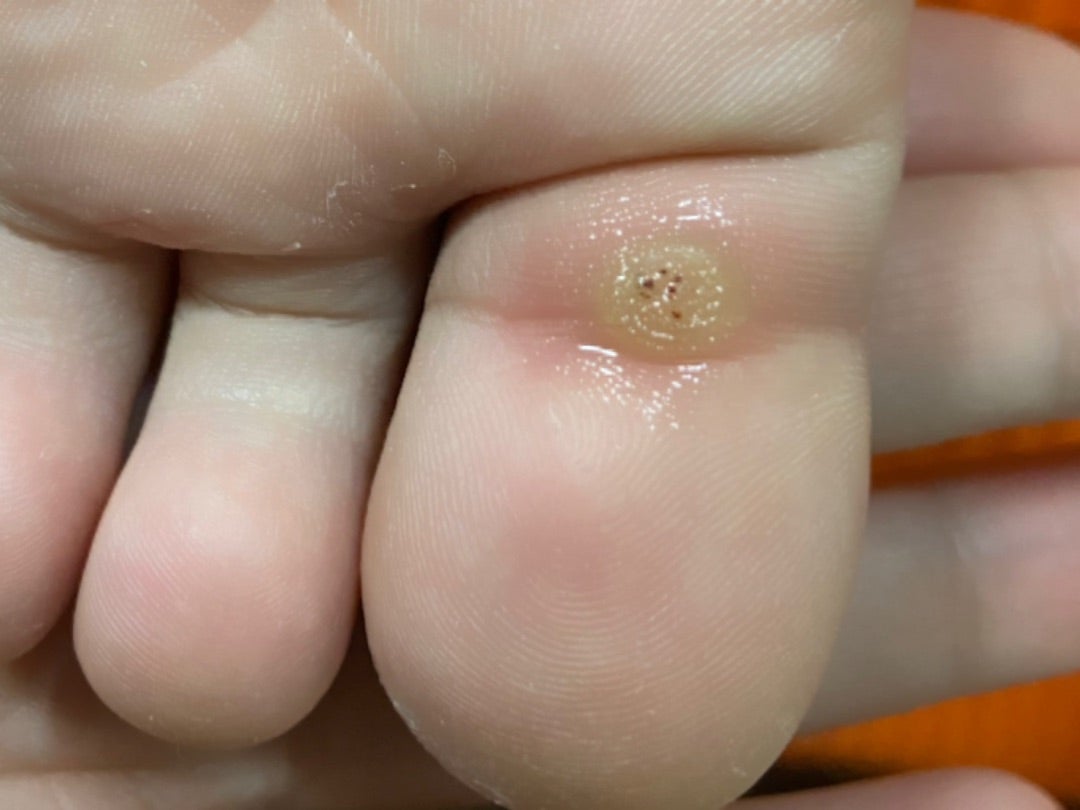 イボ②東京・新宿 フットケア専門店 Ruamarryルーアマリー