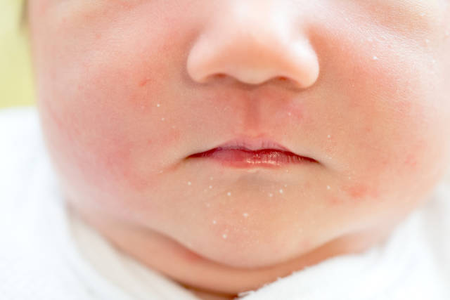 赤ちゃんの肌がこうなっていたら要注意！ 間違いがちな肌トラブルサインって？たまひよ