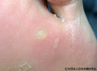 足裏の大きく治療困難なウイルス性いぼ大和駅前いなば皮膚科 旧名：大和駅前皮フ科スキンクリニック