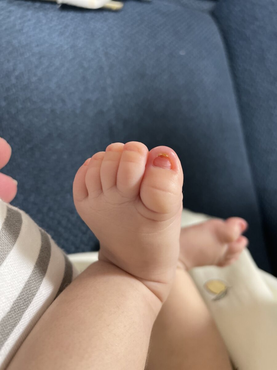 巻き爪切り方・ニッパー使い方を画像で解説大田区大森・大木皮膚科