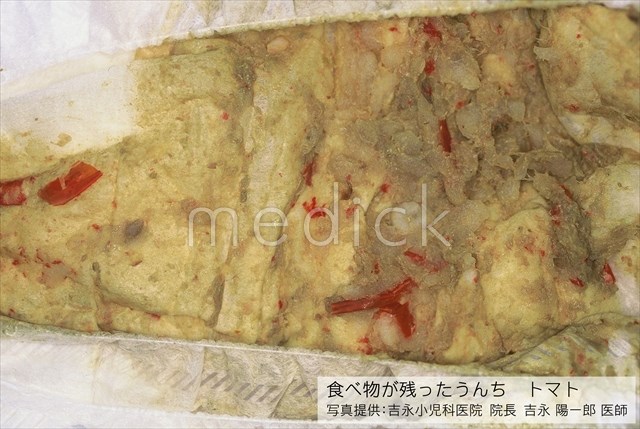 赤ちゃんのうんちの色が白っぽい病院へ行く目安や原因、対処法日暮里医院 公式 東京 内科 外科 小児科 皮膚科 予防接種