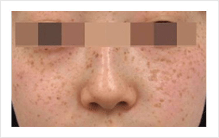 そばかす除去レーザー治療大船T's形成クリニック