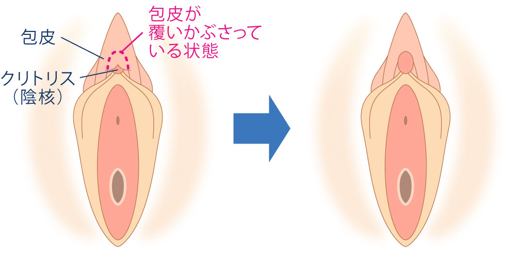 女性の包茎とは？クリトリス包茎における一般的な悩みと対処法 - アトムクリニック