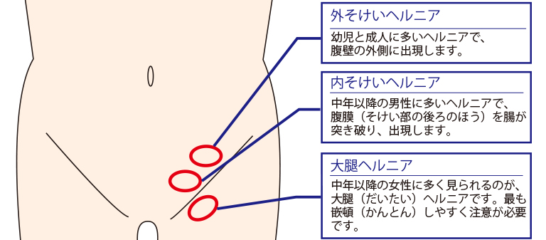 鼠径ヘルニアとよく見間違える疾患 - 鼠径ヘルニア(脱腸)日帰り手術専門