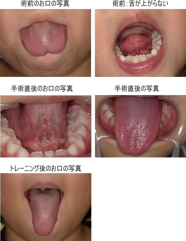 舌ピを初めて開けました。斜めになってしまったのですが気になりますか - Yahoo!知恵袋