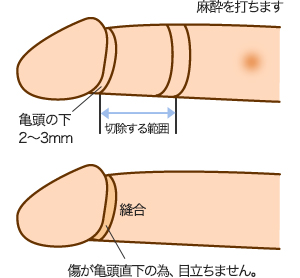 包茎とED（勃起不全）について｜【浜松町第一クリニック】