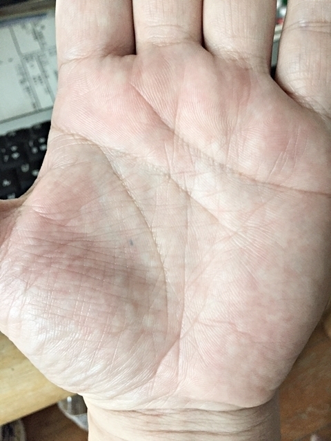 新生児のほくろについて知ろう！注意が必要なほくろや除去方法 - teniteo テニテオ