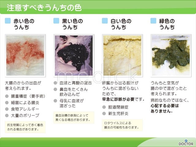 YWJLQH 感覚の発達と調整のための子供の回転便, 白 胆道閉鎖