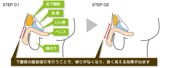 クリアランス 亀頭収監ペニスプラグ