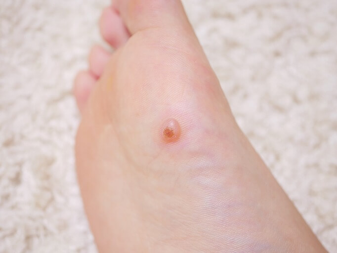 いぼ野田市 小児科 千葉県 こどもの花粉症 こどもの漢方 喘息 アトピー性皮膚炎 アレルギー 結節性痒疹 たんぽぽこどもクリニック