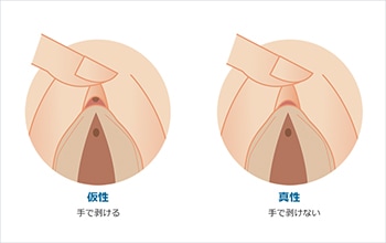 女性の包茎】クリトリス包茎とは？原因や影響を徹底解説！│SELECT CLINIC TIPS