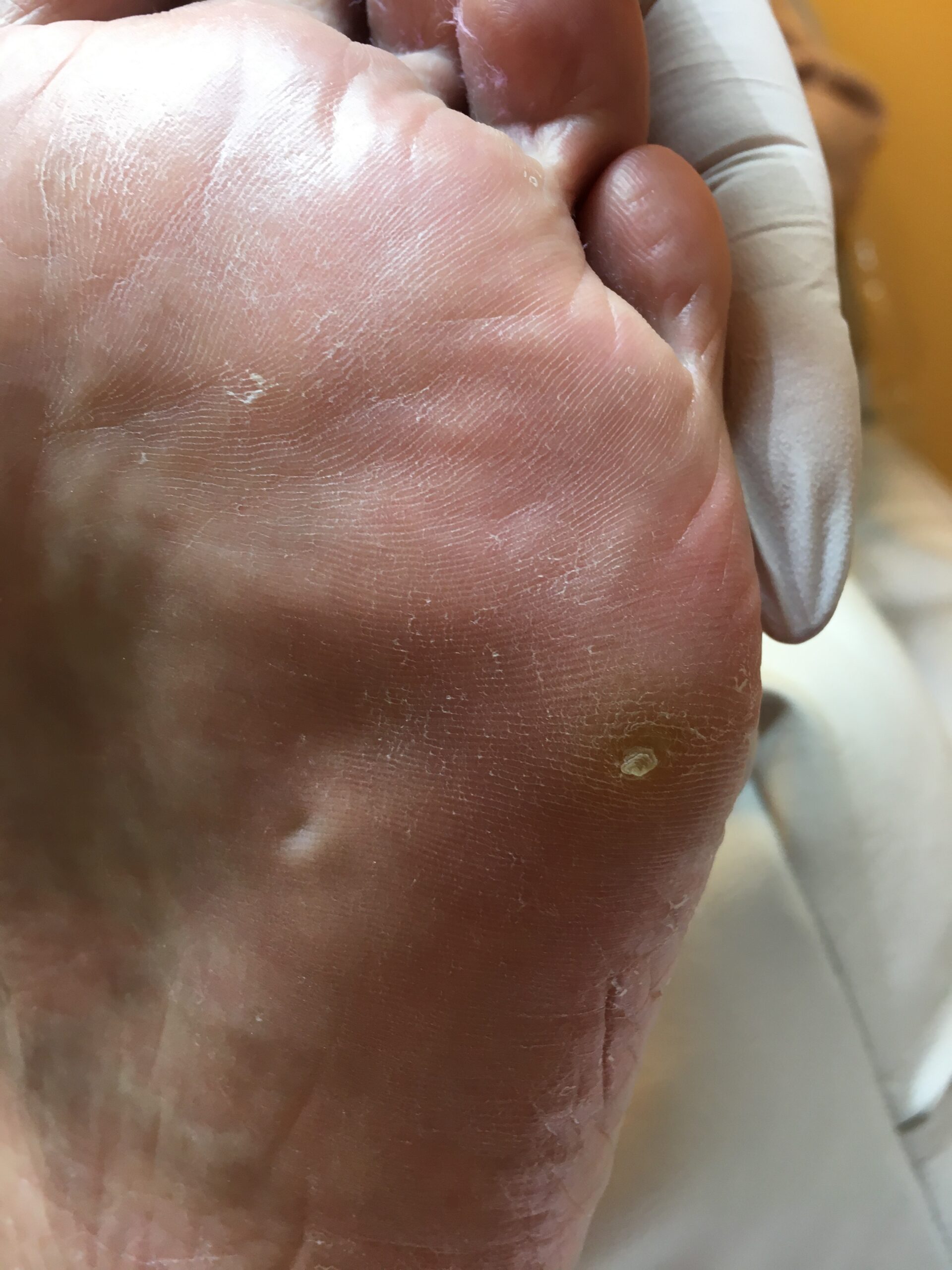 足の裏にイボを見つけたら ウイルス性のイボについて 菊池 守 足と美容、再生医療