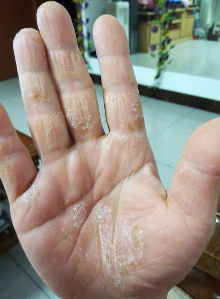 手のひらのほくろで占おう！死にほくろ・活きほくろの意味やほくろの位置ごとの運勢