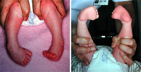 赤ちゃんの足裏から読み取る体温サイン