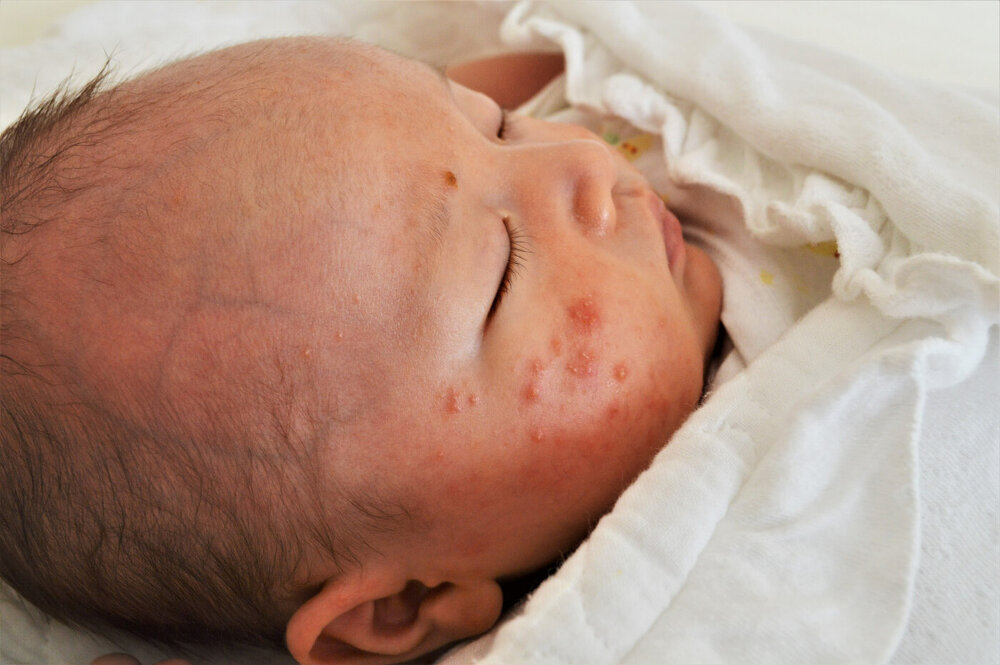 赤ちゃんの湿疹 乳児湿疹についてみしま小児科クリニック青葉台
