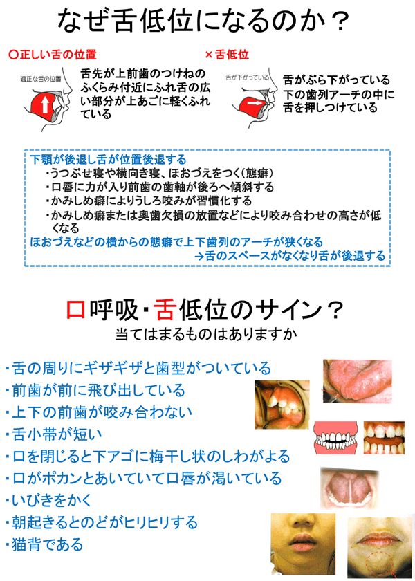 新生児が舌をよく出す ダウン症？たーちゃんねる.のブログ