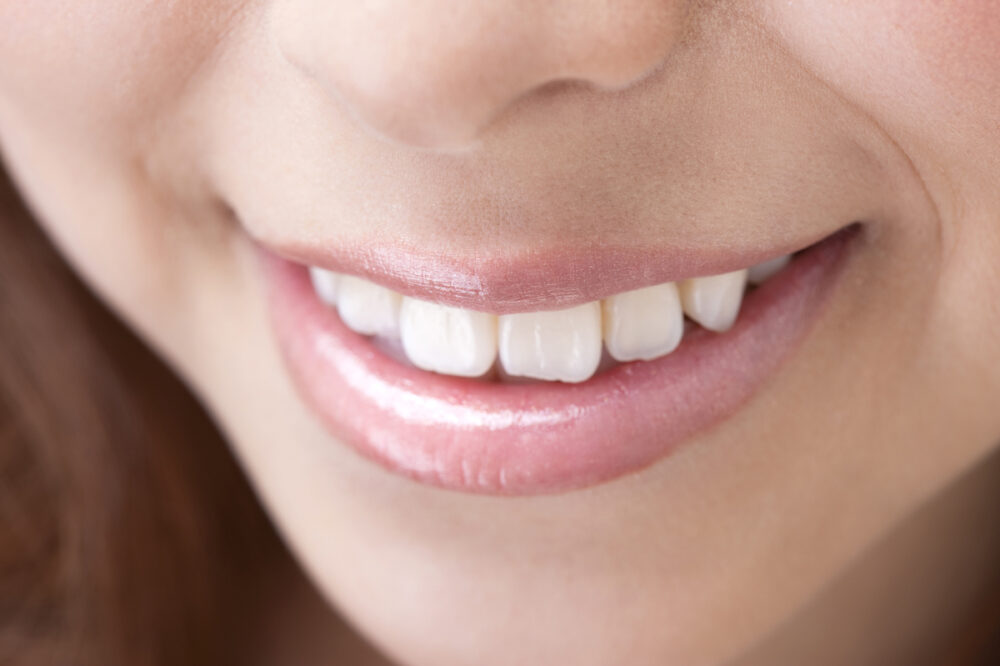 前歯のでこぼこ 29歳 女性モンテ矯正歯科クリニックまちの歯ならび・かみ合わせ相談室 福岡市東区