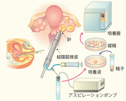 精子が寿命を迎える年齢とは ～精子“老化”の新事実～ - NHK クローズアップ現代