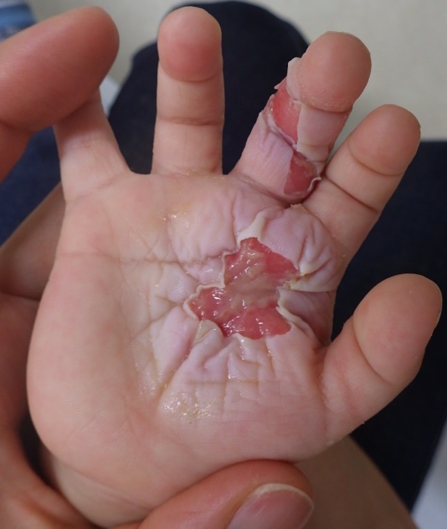 トゲ？ほくろ？？ 赤ちゃんの心と体 ベビーカレンダー専門家相談