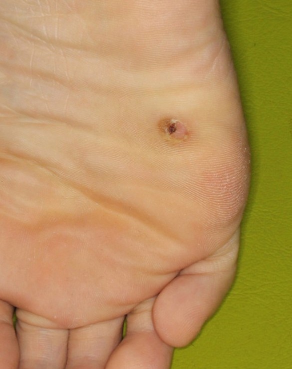 娘の手強いイボが半年で完治しました