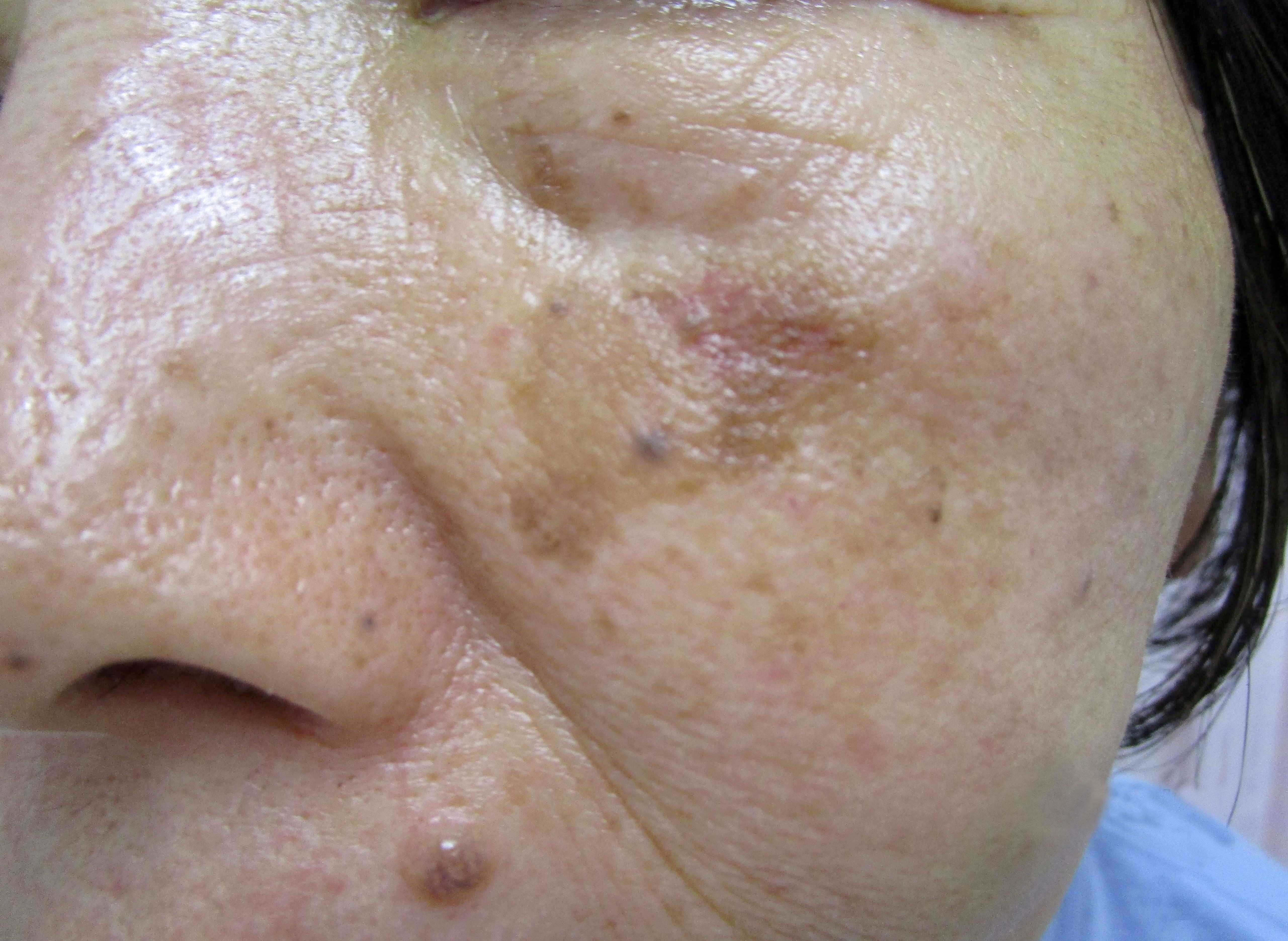 シミ取り治療・レーザーならコアラ皮膚科・美容皮膚科クリニック三軒茶屋三軒茶屋・池尻大橋・駒沢大学・若林・世田谷