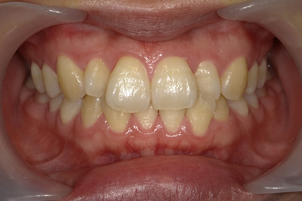 大きい前歯の原因と治療方法 部分矯正で目立たず治すマウスピース矯正・裏側矯正の矯正歯科吉祥寺デンタルクリニック