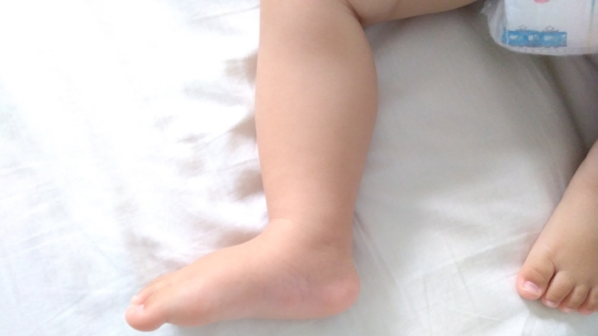 足の指にみられさわると冷たい湿疹野田市 小児科 千葉県 こどもの花粉症 こどもの漢方 喘息 アトピー性皮膚炎 アレルギー 結節性痒疹たんぽぽこどもクリニック