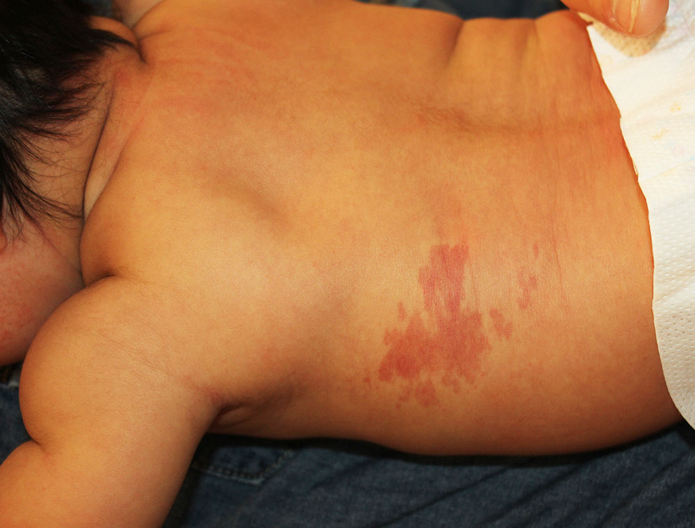 蒙古斑 - Wikipedia