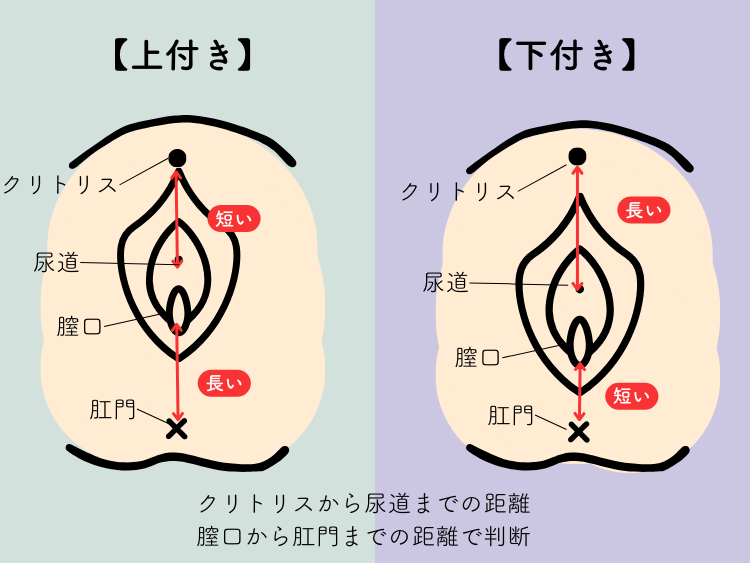 症例13 49歳男性 ペニス上反り形成術・屈曲ペニス修正術・包茎手術 | 症例写真・体験談｜包茎・ED治療など男性形成なら銀座みゆき通り美容外科