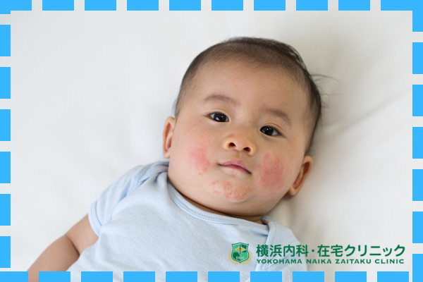 赤ちゃんのすべすべお肌に赤いポツポツが 乳児湿疹から学びました比島交通公園・山ちゃん！新米パパになりました④ココハレ -高知の子育て応援ウェブメディア