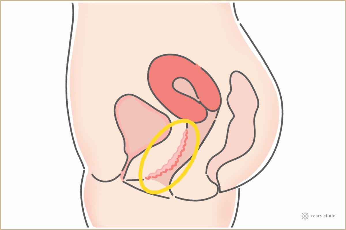 15.女性生殖器 (1)外陰部尖圭コンジローマ|病理コア画像