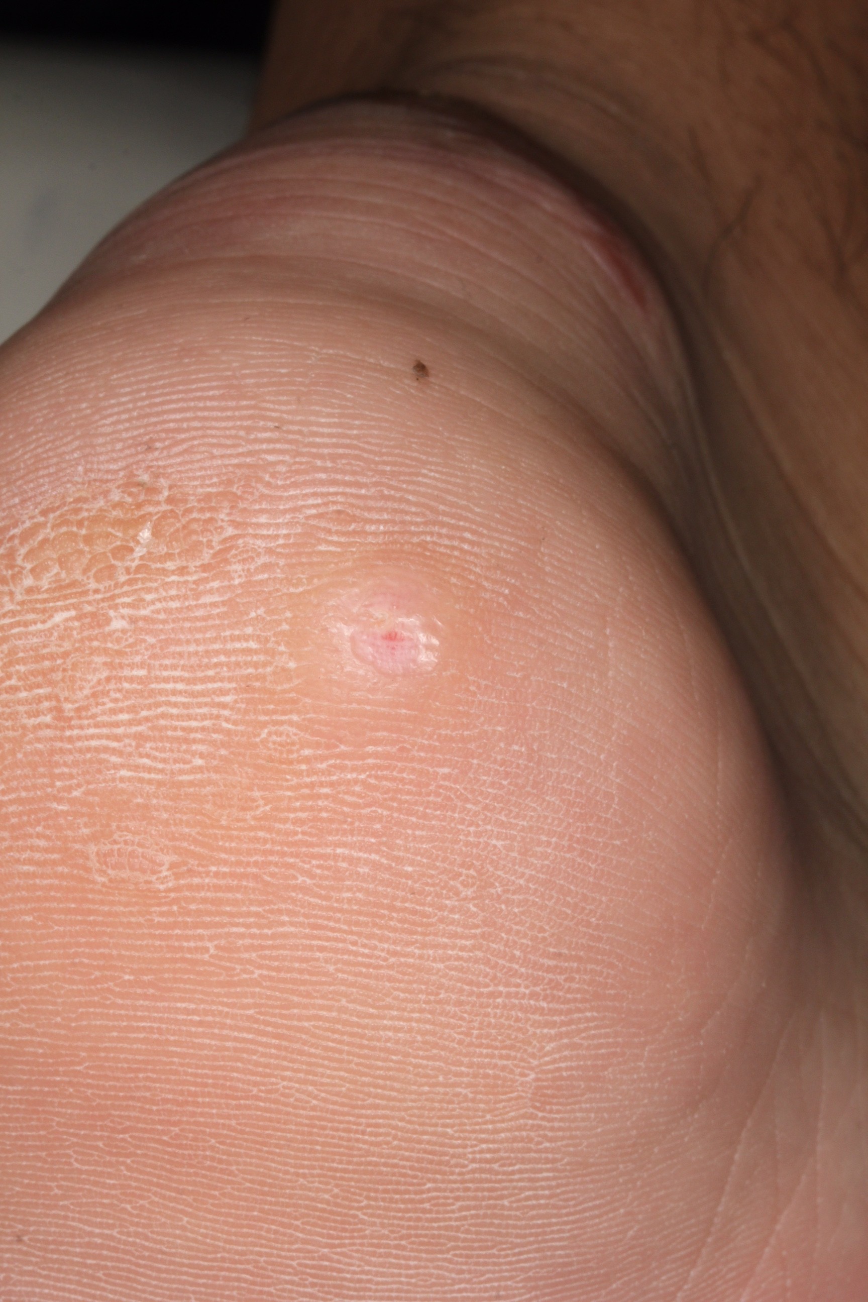 炭酸ガスレーザ