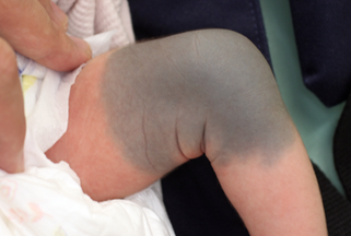 もしかしてこれも蒙古斑？さら助産院「母乳育児とべビマ、そして性教育」Powered by Ameba