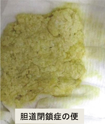 便の色 うんちの色 がいつもと違う 緑色・黒色・白色 越谷の北越谷そめやクリニック