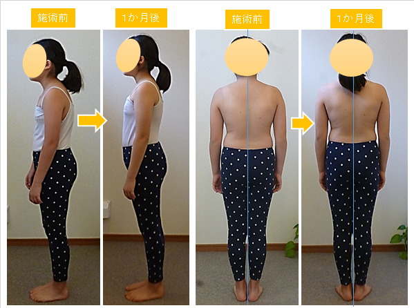 猫背 猫背矯正ベルト 子供用 姿勢矯正ベルト 子供用 女の子 姿勢補正 キッズ 背筋矯正ベルト 姿勢サポーター 姿勢矯正サポーター 男の子 矯正ベルト背筋 サポーター 子供 ベルト 通気性 補正 解消 改善 ゆがみ 肩こり 腰痛 肩こり 成長 プレゼント 送料無料の通販はau