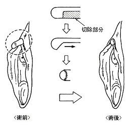 小陰唇縮小・すそわきが｜横浜で美容外科・美容整形なら横浜中央クリニック