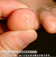 イボ・イボ取り千葉県船橋市北習志野のふじもと皮膚科クリニック