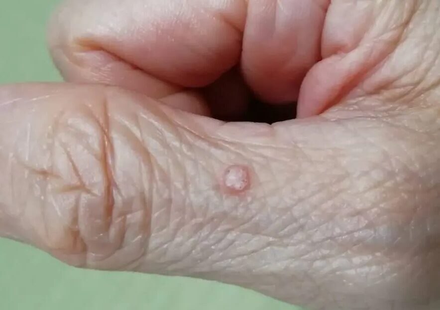 老人性血管腫 赤ほくろ は放置しても大丈夫？気になる対処方法赤ちゃん・子供のあざ治療なら最新レーザー治療×形成外科専門医の大阪梅田形成クリニック